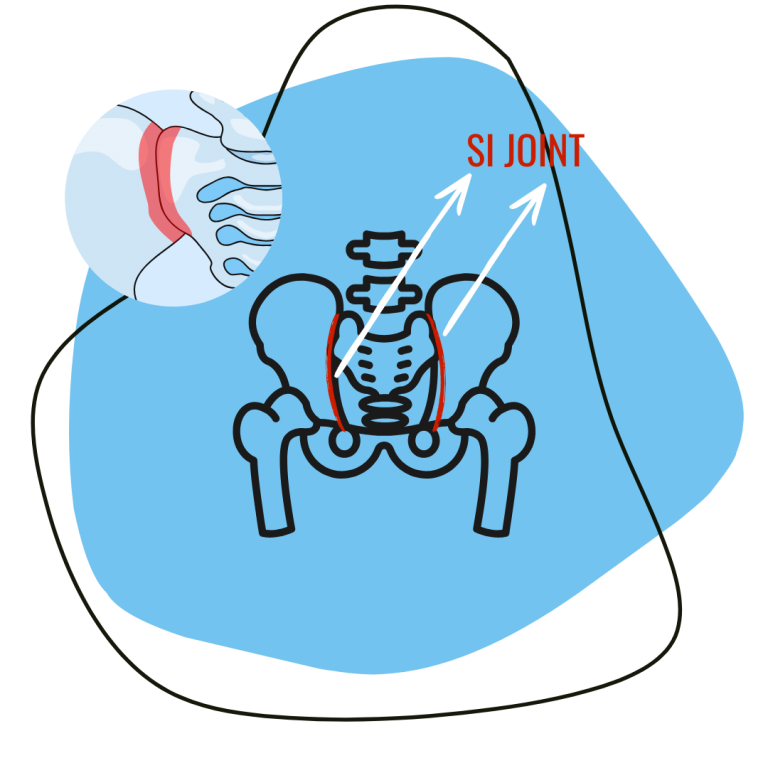 Pain in the leg? Differentiating sciatica vs SI joint pain